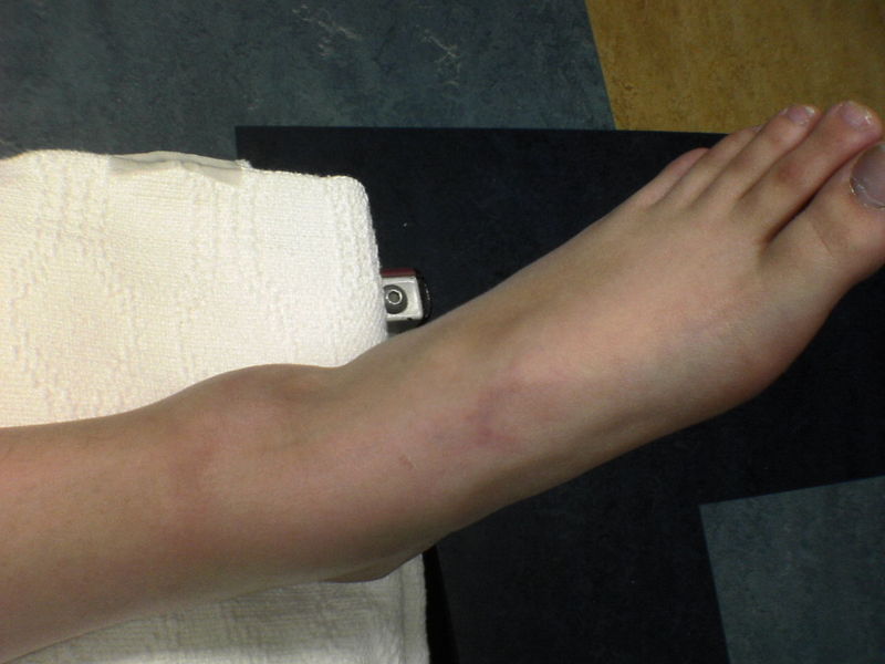 nchanter's foot in emergency room (no broken bones)